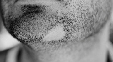 Unraveling Beard Alopecia: Causes, Symptoms, and Effective Treatments - Beard Beasts
